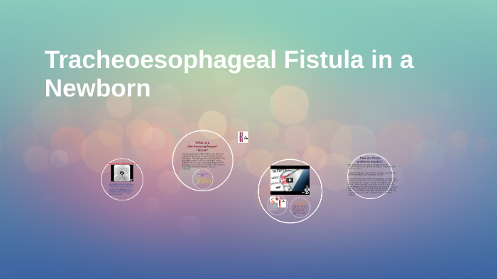 Tracheoesophageal Fistula In A Newborn By Mayi Amor