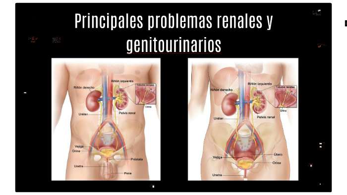 próstata agrandada con hidronefrosis bilateral próstata agrandada con hidronefrosis bilateral