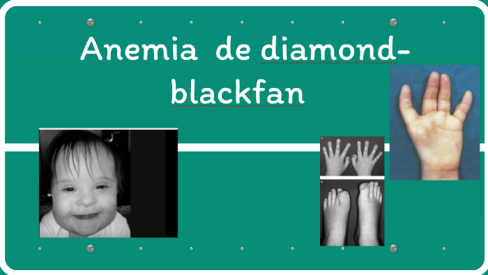 Anemia De Anemia De Diamond-blackfan By Karla Álvarez On Prezi