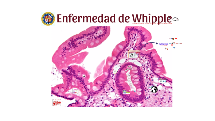 como se diagnostica whipple