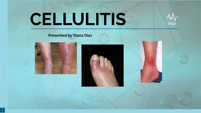 CELLULITIS by diana Diaz