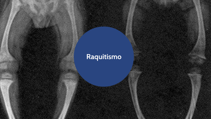 rayos x de raquitismo