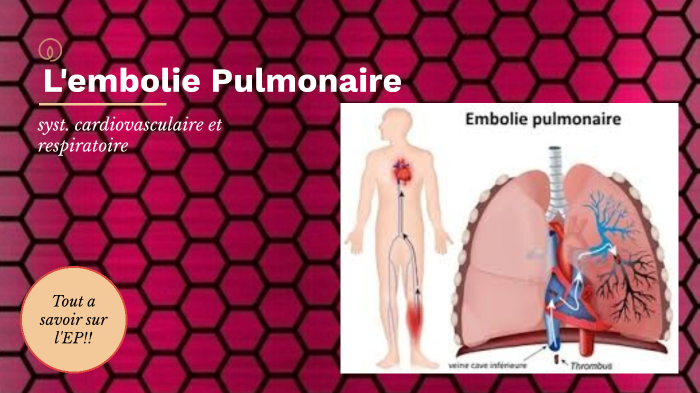 Embolie pulmonaire by geneviève etienne on Prezi