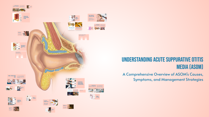 Understanding Acute Suppurative Otitis Media (ASOM) by bernice a on Prezi