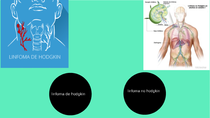 linfoma de hodgkin y no hodgkin by brayan herrera on Prezi