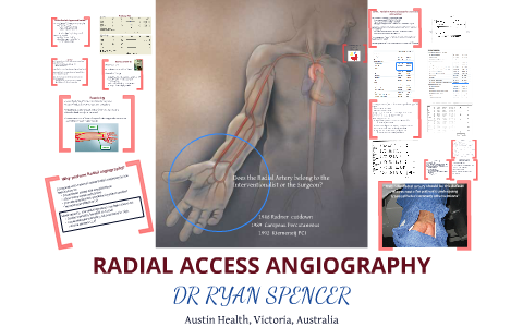 Access Rra Angiogram Radial Access Coronary Angiography by Ryan Spencer on Prezi