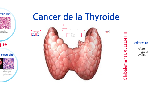 diagramme du cancer de la thyroïde