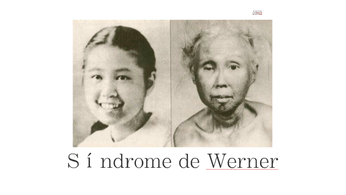 Síndrome de Werner by Ana Matute on Prezi