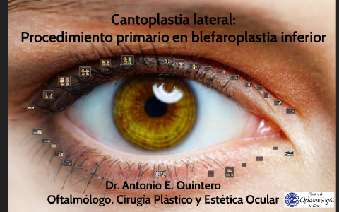 Cantoplastia Lateral Procedimiento Primario En Blefaroplast By Antonio Quintero