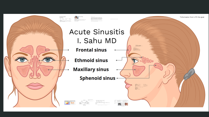 acute-sinusitis-by-ishan-sahu