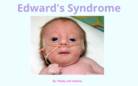 Syndrome edward Edward's Syndrome:
