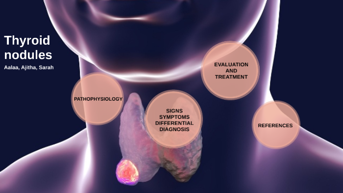 thyroid-nodules-by-ajitha-kulasekaran-on-prezi