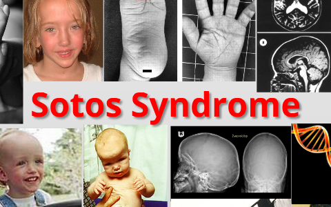 Sotos Syndrome by Deborah Ortega on Prezi