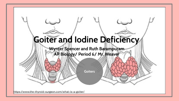 icd 10 code for iodine deficiency related goiter