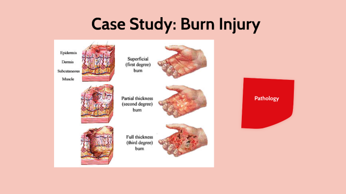 Burn Injury By Sadari Phillips On Prezi