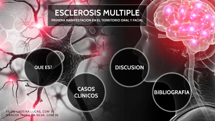 Esclerosis multiple como primera manifestacion en el territorio oral y ...