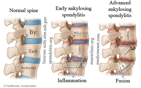 Ankylosing Spondylitis by Zach Burkholder on Prezi