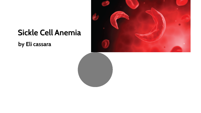 sickle sell anemia by Student Elijah Cassara