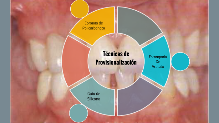 Técnicas de Provisionalización by Anyelina Belén Rodríguez Sáez on Prezi