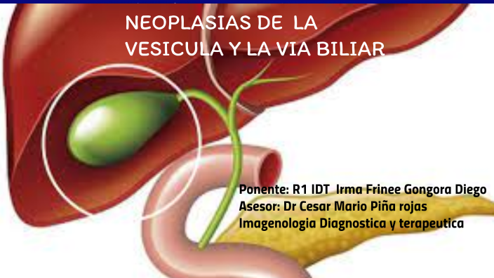 Neoplasias de la vesicula y via biliar by Frinee Gongora on Prezi