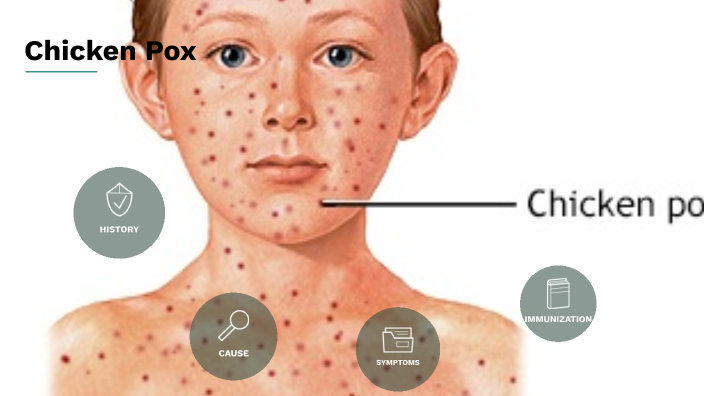 Chicken Pox by Janice Jean-noel on Prezi