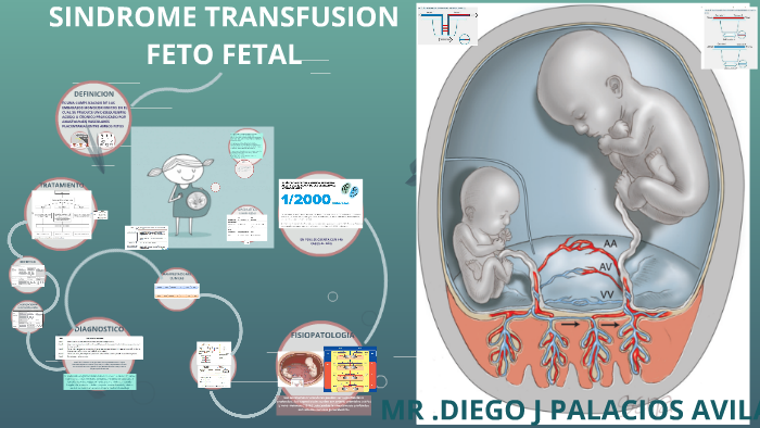 Feto Fetal Transfusion Syndrome SINDROME TRANSFUSION FETO FETAL by diego palacios on Prezi