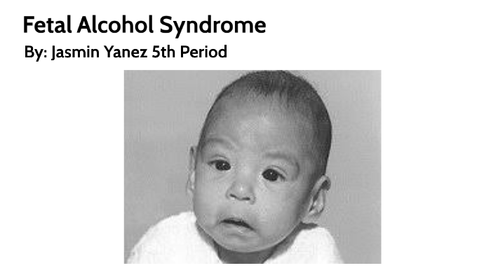 Fetal Alcohol Syndrome by jasmin yanez on Prezi