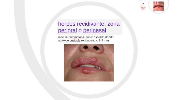 does oral melanotic macule go away Lesiones marrones en la lengua