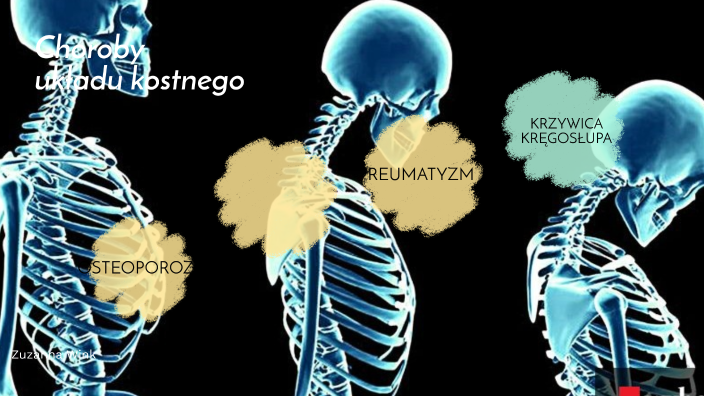 Klasuwka Onet Pl Sprawdzian Z Ukladu Kostnego Choroby układu kostnego by Zuzanna Wink on Prezi