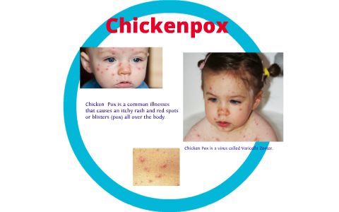 Chicken Pox-Child Development by Ursula Abelsen