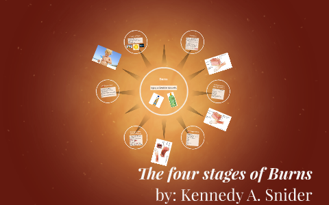 The four stages of Burns by Kennedy Snider on Prezi