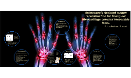 Arthroscopic Assisted Tendon Reconstruction For Triangular F By Amin Hasan