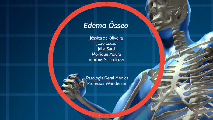 Edema Ósseo by Monique Moura