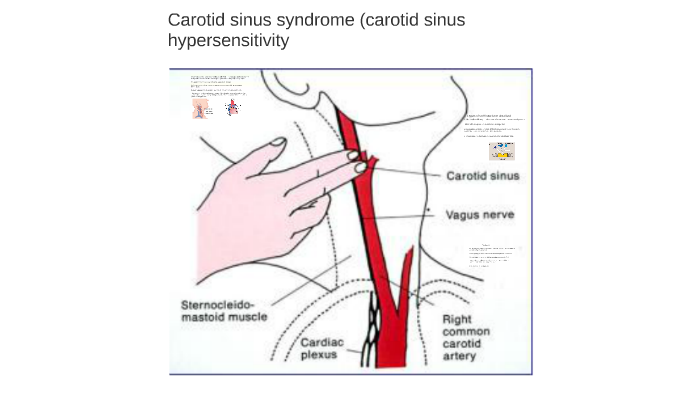 Carotid sinus syndrome by Feroza Patel on Prezi