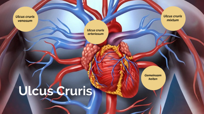 Ulcus Cruris By Jennifer Otto On Prezi