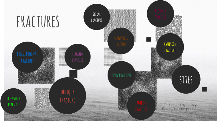 10 types of fractures by lessly rodriguez on Prezi