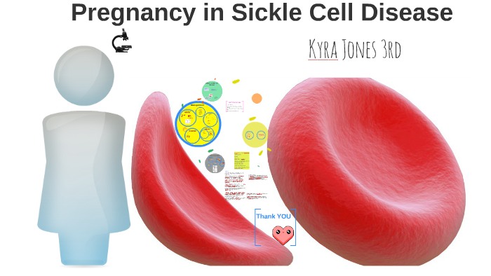 Pregnancy in Sickle Cell Disease by Kyra Jones on Prezi