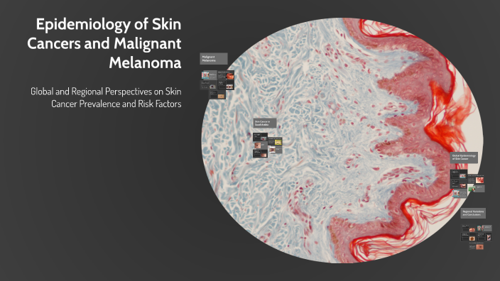 Epidemiology of Skin Cancers and Malignant Melanoma by B H on Prezi