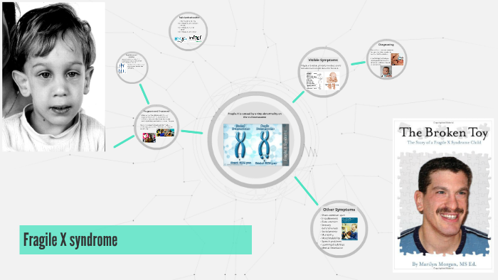 Fragile X syndrome by Tara Kathleen on Prezi