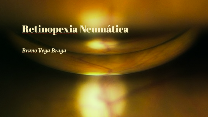 Retinopexia Neumática by Bruno Braga on Prezi