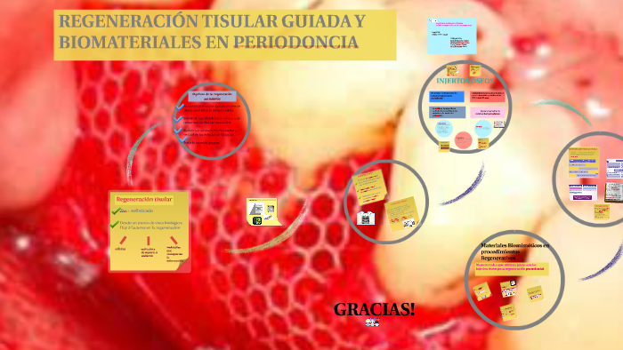 REGENERACION TISULAR GUIADA Y BIOMATERIALES EN PERIODONCIA By Marie regeneracion-tisular-guiada-y-biomateriales-en-periodoncia-by-marie