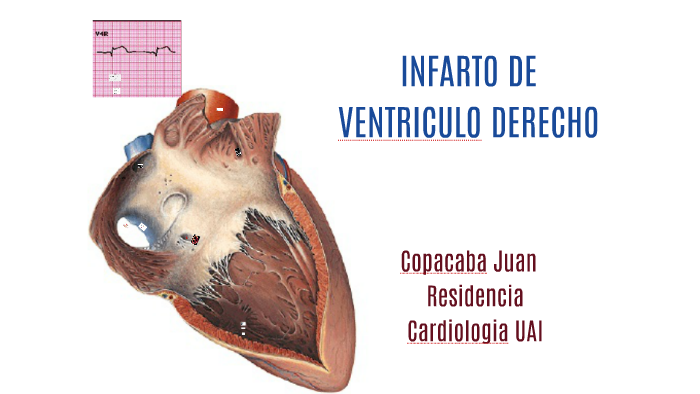 INFARTO DE VENTRICULO DERECHO by juan carlos copacaba on Prezi