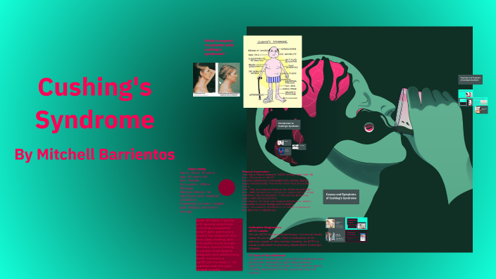 Cushing's Syndrome by Mitchell Barrientos on Prezi