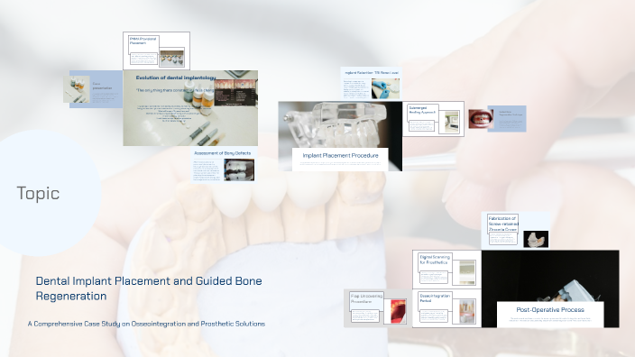 Dental Implant Placement and Guided Bone Regeneration by on Prezi