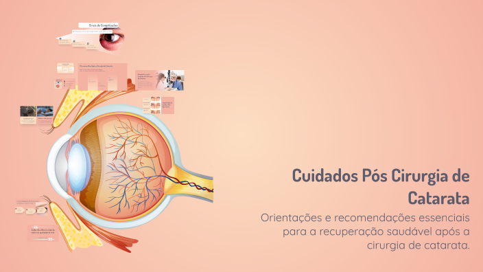 Cuidados P s Cirurgia De Catarata By Isadora Oliveira On Prezi cuidados-p-s-cirurgia-de-catarata-by-isadora-oliveira-on-prezi