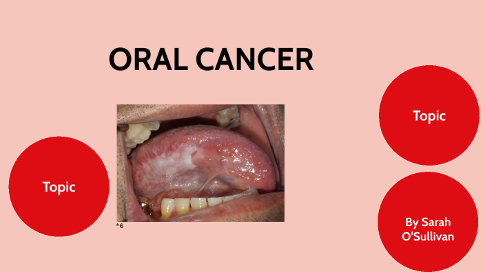 oral cancer case presentation