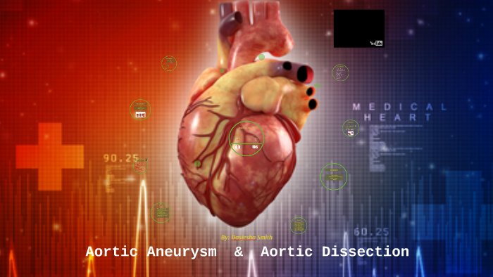 Aortic Aneurysm/ Aortic Dissection by Dasjesha Smith on Prezi