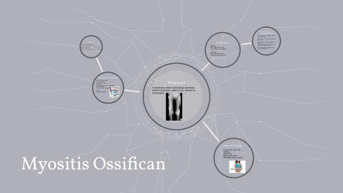 Myositis Ossificans By Jack Mckelley On Prezi