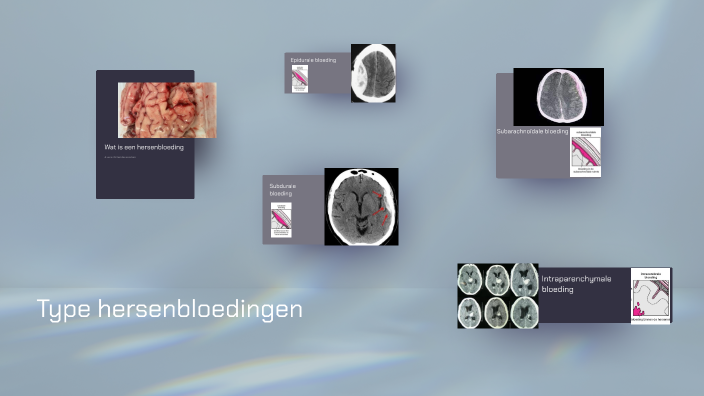 Types Of Brain Hemorrhages By Maud Schoemaker On Prezi Types Of Brain Hemorrhages By Maud Schoemaker On Prezi
