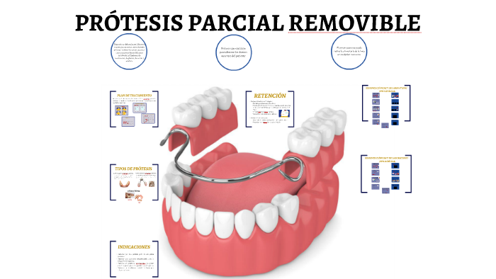 Componentes De Una Protesis Parcial Removible prezi.com